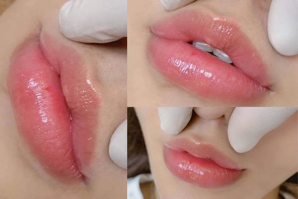 Từ Vụ TắC MạCh MáU Do TiêM Filler MôI, ChuyêN Gia KhuyếN CáO đIềU Quan TrọNg - ẢNh 1.