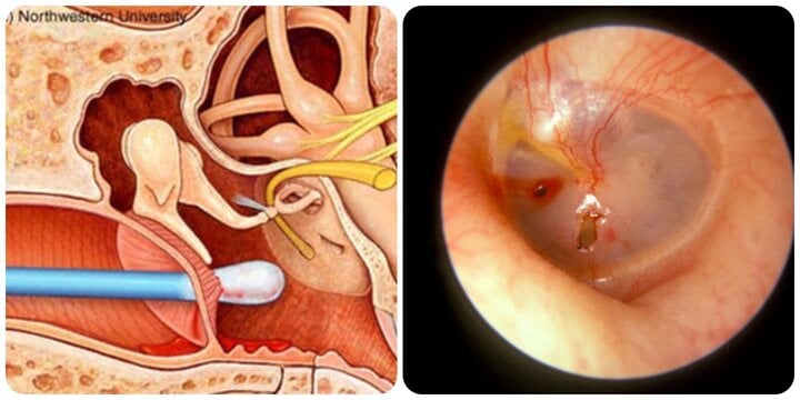 HậU Quả CủA ViệC ThườNg XuyêN NgoáY Tai - ẢNh 1.