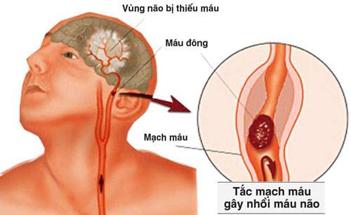 Bệnh Rối Loạn Tuần Hoàn Não: Nguyên Nhân, Triệu Chứng Và Cách Điều Trị 1