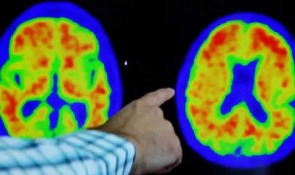 Thuốc Donanemab - Đột Phá Trong Việc Điều Trị Bệnh Alzheimer 1