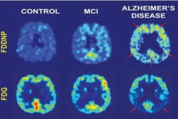 Ứng Dụng Kỹ Thuật Pet Và Pet/Ct Trong Lâm Sàng 2