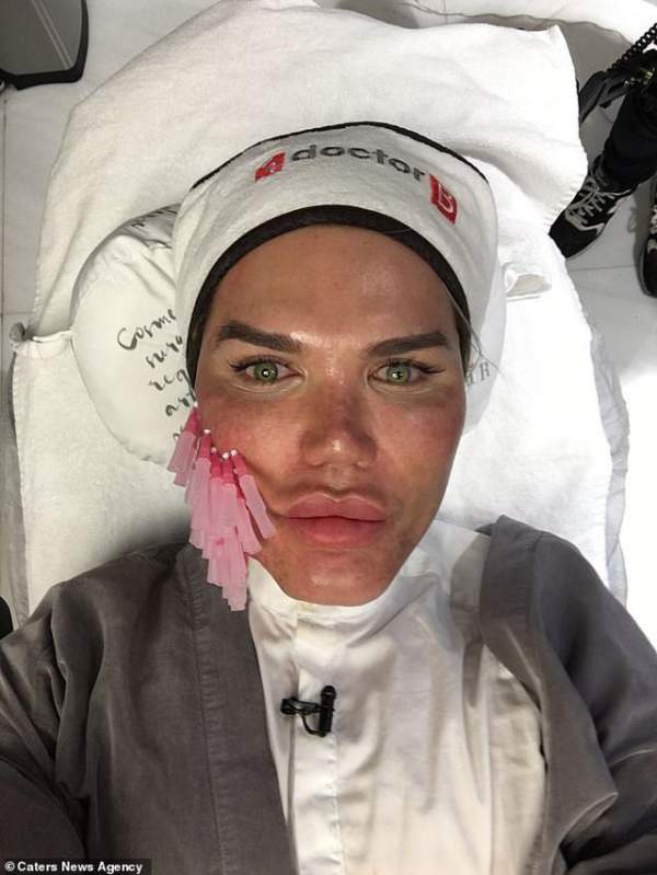 Gương Mặt Sưng Phồng Đáng Sợ Của Rodrigo Alves Sau Ca “Dao Kéo” 3