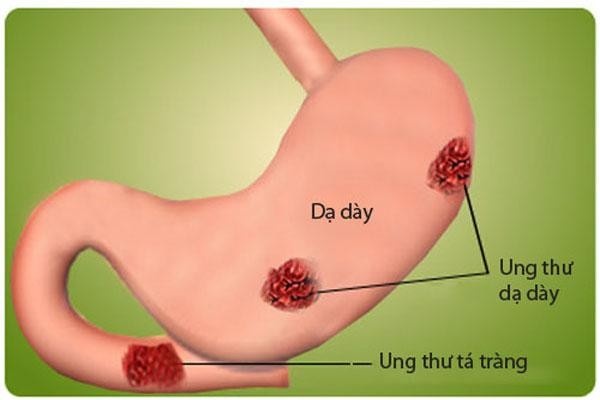 Các Yếu Tố Nguy Cơ Và Triệu Chứng Ban Đầu Của Bệnh Ung Thư Dạ Dày 1