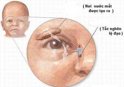 Tắc Lệ Đạo Và Cách Xử Trí 1