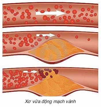 Rối Loạn Lipid Máu Và Nguy Cơ Bệnh Tim Mạch 3