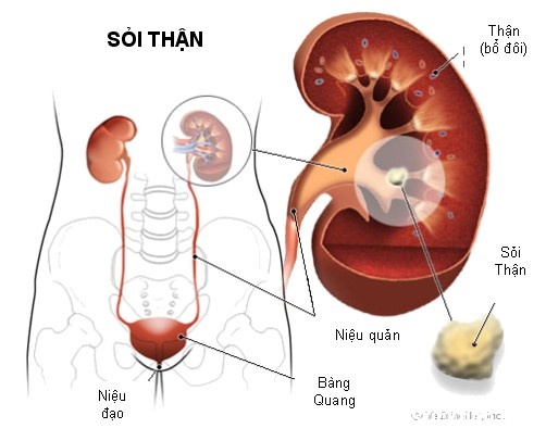 Đông Y Trị Sỏi Tiết Niệu 1