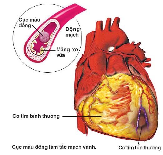 Xơ Vữa Động Mạch - Ngõ Vào Của Nhiều Bệnh Chứng 2