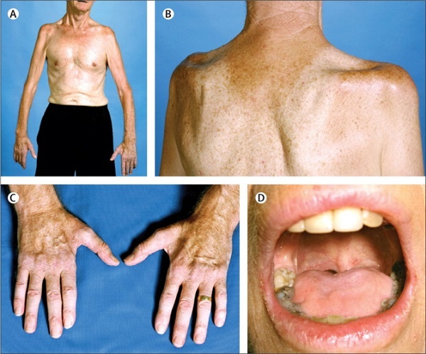 Tìm Hiểu Căn Bệnh Quái Ác Đằng Sau Thử Thách &Quot;Dội Nước Đá Lên Người&Quot; 10