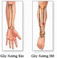 Làm Sao Biết Bị Gãy Xương 1