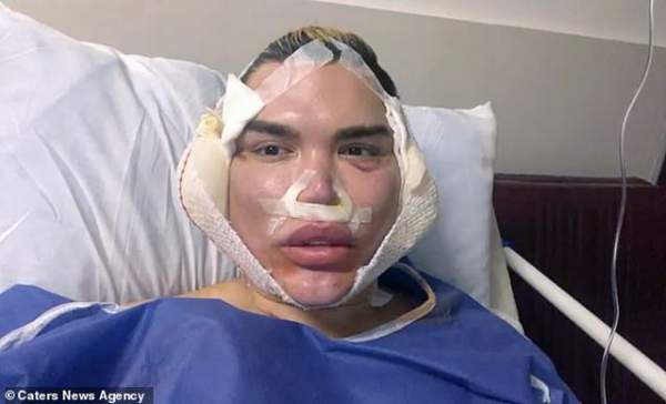 Gương Mặt Sưng Phồng Đáng Sợ Của Rodrigo Alves Sau Ca “Dao Kéo” 1