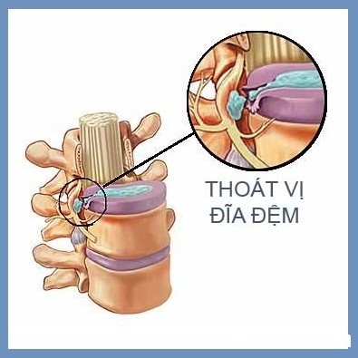 Làm Thế Nào Để Chữa Một Đĩa Đệm Đã Bị Thoái Vị? 1