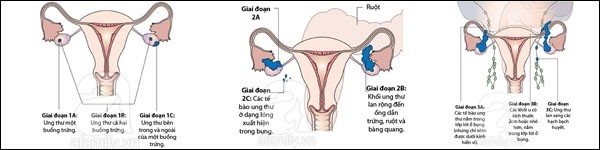 3 Bệnh Viêm Nhiễm Đe Dọa Sức Khỏe Phụ Nữ Nhiều Nhất 2