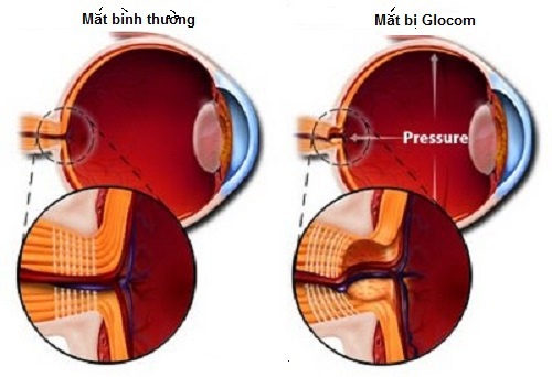 Mờ Mắt Nhanh, Chớ Coi Thường 1