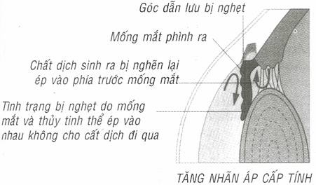 Những Bệnh Ở Mắt Có Thể Dẫn Đến Mù Lòa 3