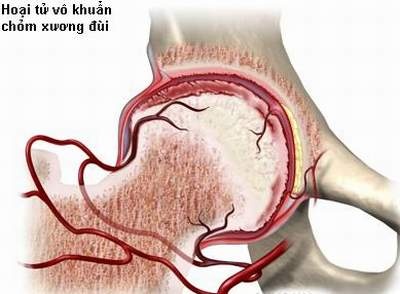 Hoại Tử Chỏm Xương Đùi - Ai Dễ Mắc? 1