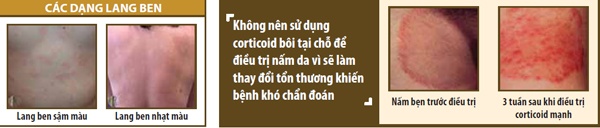 Bệnh Nấm Da Và Biện Pháp Phòng Trị Hiệu Quả 3