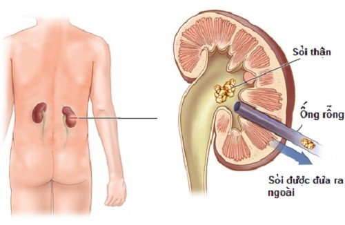 Không Nên Chủ Quan Với Bệnh Sỏi Thận 1