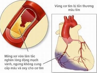 Thuốc Điều Trị Nhồi Máu Cơ Tim Và Những Khuyến Cáo 1