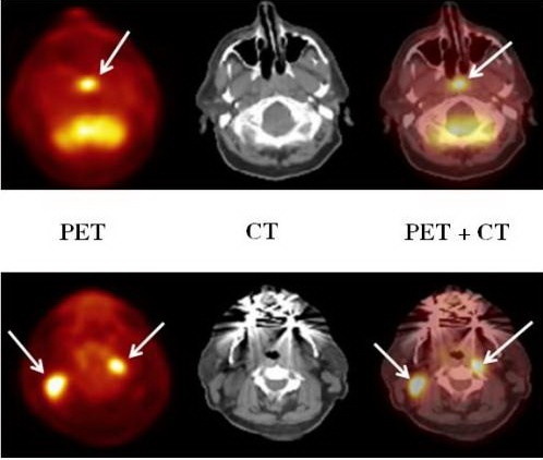 Ứng Dụng Kỹ Thuật Pet Và Pet/Ct Trong Lâm Sàng 6