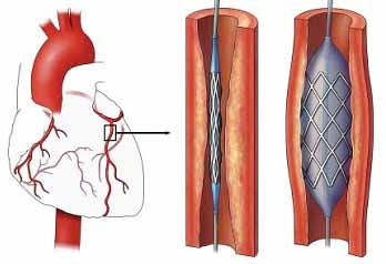 Rối Loạn Lipid Máu Và Nguy Cơ Bệnh Tim Mạch 2